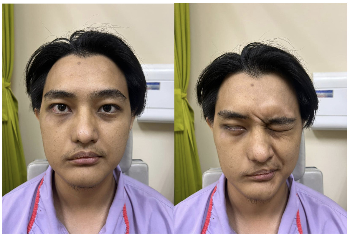 Pre-operative photograph taken 19 days post-trauma of right longitudinal temporal bone fracture, showing right facial nerve palsy House-Brackmann Grade V
