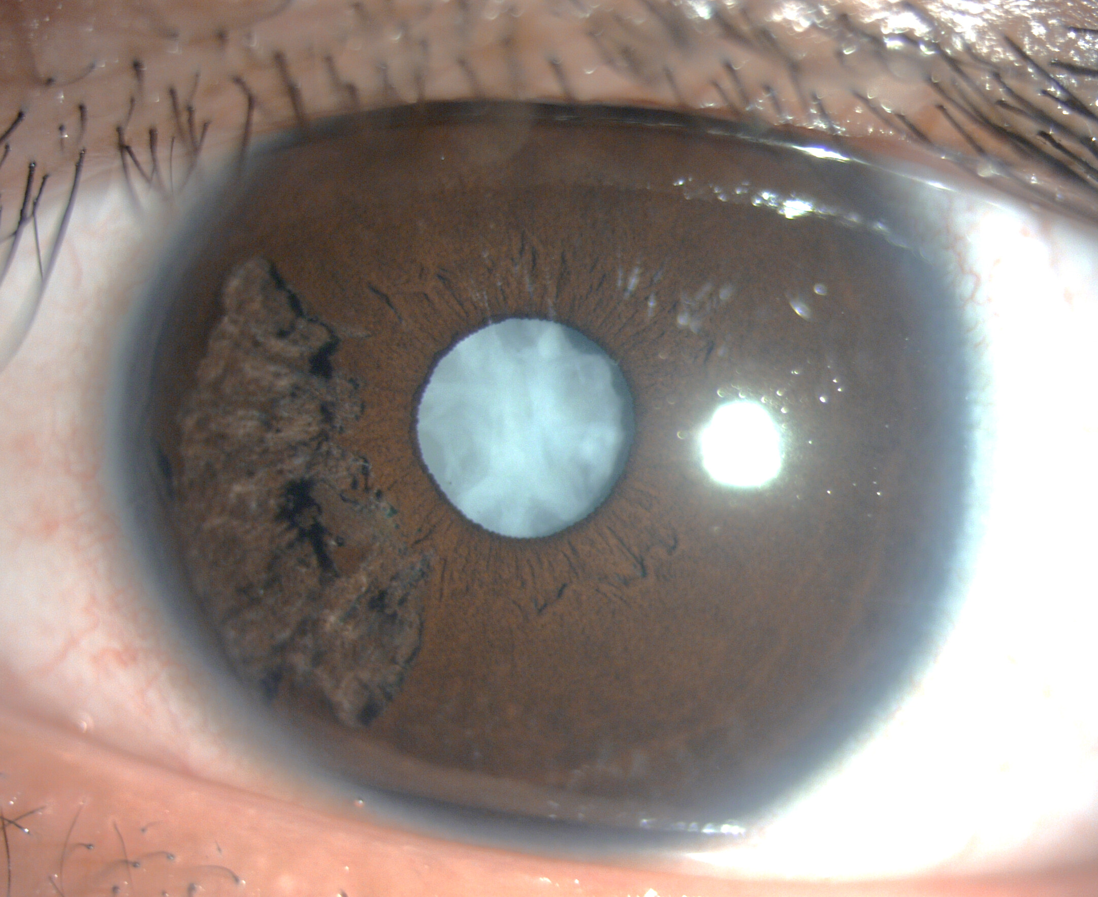 FIGURE 1: Photo of left eye showing sectoral iridoschisis and a dense white cataract