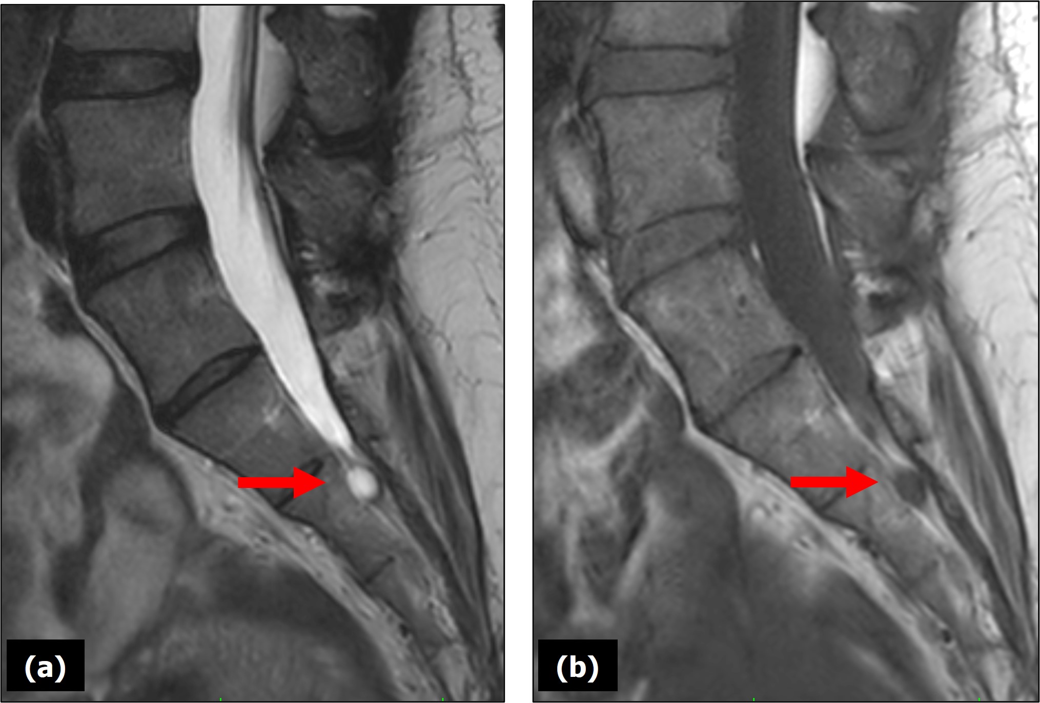 (a) Sagittal T2-weighted and (b) sagittal T1-weighted MRI images of the lumbosacral spine. The red arrows pointed to a Tarlov cyst at the S2 level. On the T2-weighted image, the cyst appearred hyperintense (bright), reflecting its fluid content consistent with cerebrospinal fluid (CSF). In the T1-weighted image, the lesion was isointense to the CSF. The cyst was located within the sacral canal.