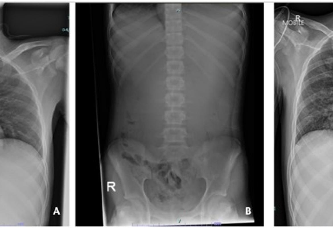 FIGURE 1: (A) Chest radiograph revealed an elevated left hemidiaphragm with absent of gastric bubble; (B) Abdominal radiograph revealed a paucity of small bowel gases that suggest proximal intestinal obstruction; (C) Chest radiograph taken post-intubation revealed bilateral alveolar opacities after the patient aspirated