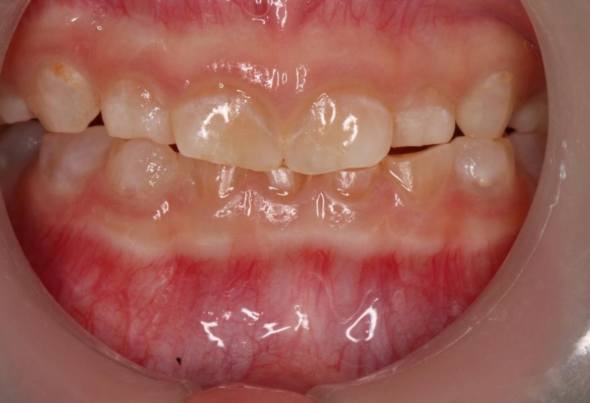 Anterior view of the dentition before treatment