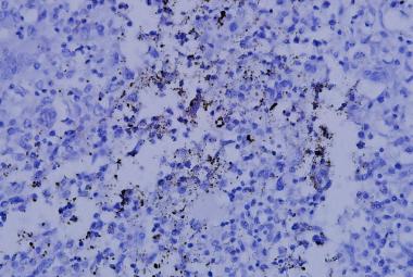 Positive NFATc1 from a 16-year-old boy with osteoblastic osteosarcoma distal femur. After the surgical resection, he underwent 6 courses chemotherapy with 95% necrosis. NFATc1 was found to be positive as shown, and he survived 10 years disease free (NFATc1: Nuclear factor of activated T cells c1)
