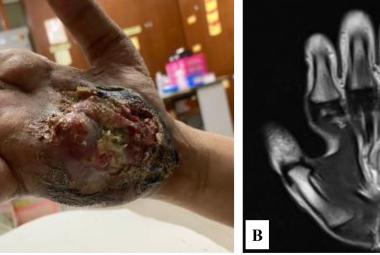 Case 1 (A) A fungating and ulcerated soft tissue mass over the hypothenar region of the right hand; (B) Coronal T1-weighted MR image showing a lobulated, homogeneous lesion involving the hypothenar muscles.