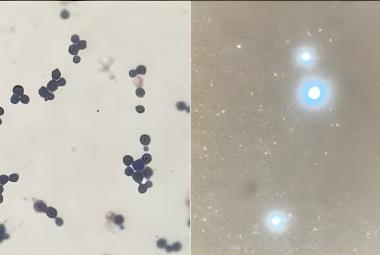 Left: Gram stain showing round yeast cells with budding; Right: India ink preparation positive for encapsulated yeasts