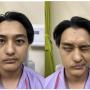 Pre-operative photograph taken 19 days post-trauma of right longitudinal temporal bone fracture, showing right facial nerve palsy House-Brackmann Grade V