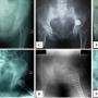 Reconstruction techniques following internal hemipelvectomy for periacetabular chondrosarcoma. Preoperative and postoperative plain radiographs demonstrated three different reconstructive approaches: (A, B) Modified total hip replacement (Case #2), (C, D) hip transposition with fusion (Case #4), and (E, F) saddle endoprosthesis (Case #6)