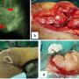 FIGURE 1: In Case #2, the patient had recurrence of left pelvic chondrosarcoma. Plain radiograph showed involvement of the ischiopubic region and ilium, indicated by the red arrows; (a) This led to the decision for an internal hemipelvectomy with hip arthrodesis using plate and screws; (b) However, he subsequently developed chronic wound infections and dehiscence, necessitating multiple debridement; (c & d) which eventually resulted in the decision for an external hemipelvectomy