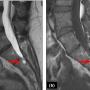 (a) Sagittal T2-weighted and (b) sagittal T1-weighted MRI images of the lumbosacral spine. The red arrows pointed to a Tarlov cyst at the S2 level. On the T2-weighted image, the cyst appearred hyperintense (bright), reflecting its fluid content consistent with cerebrospinal fluid (CSF). In the T1-weighted image, the lesion was isointense to the CSF. The cyst was located within the sacral canal.