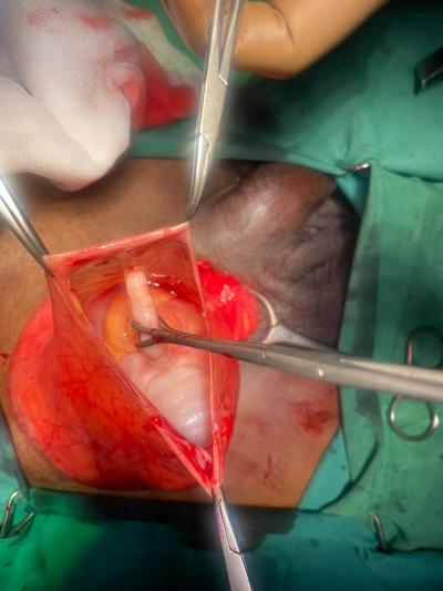 Figure 1: A vermiform-like structure was identified inside the right inguino-scrotal sac