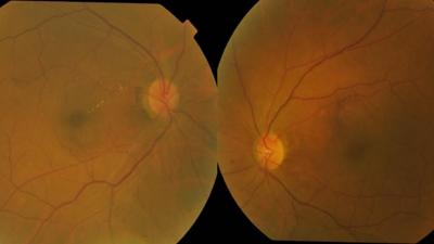 Fundus photo of patient during first presentation showing normal optic disc appearance